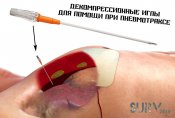 dekompressionnaja_igla_dlja_lechenija_naprjazhennogo_pnevmotraksa_enl.jpg